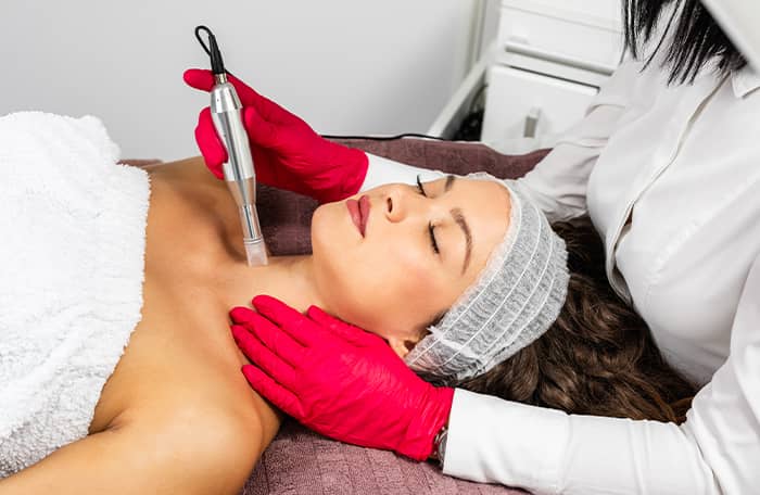 microneedling