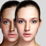 Laser Freckle removal