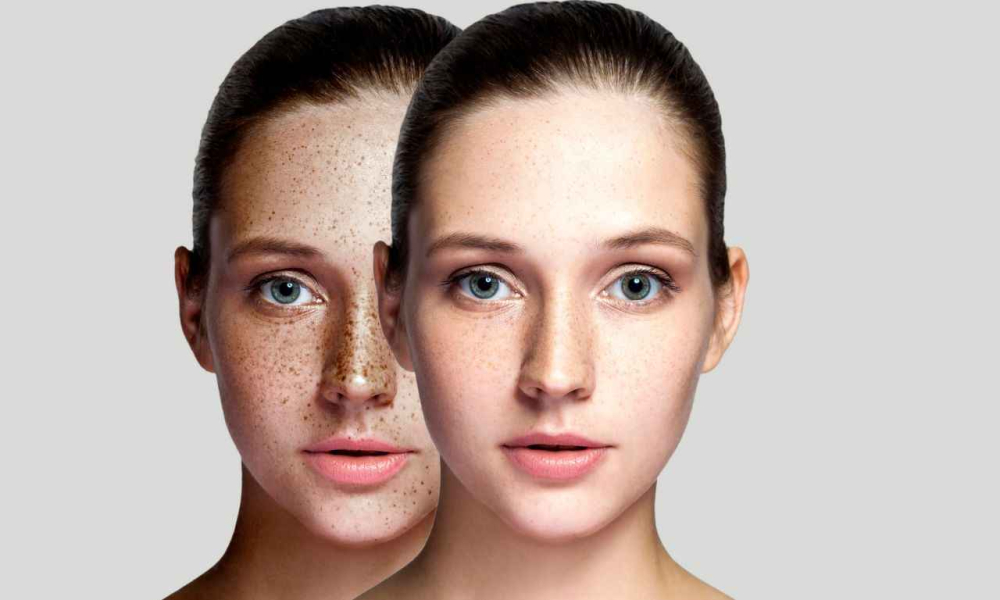 Laser Freckle removal
