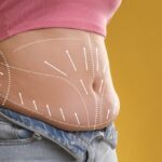 Close-up of an abdomen with white dotted contouring lines and directional arrows illustrating how does Quantum RF work to target and dissolve localized fat deposits