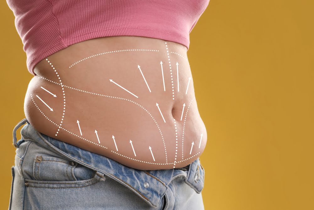How Does Quantum RF Work? The Science Behind the Results 3 Close-up of an abdomen with white dotted contouring lines and directional arrows illustrating how does Quantum RF work to target and dissolve localized fat deposits