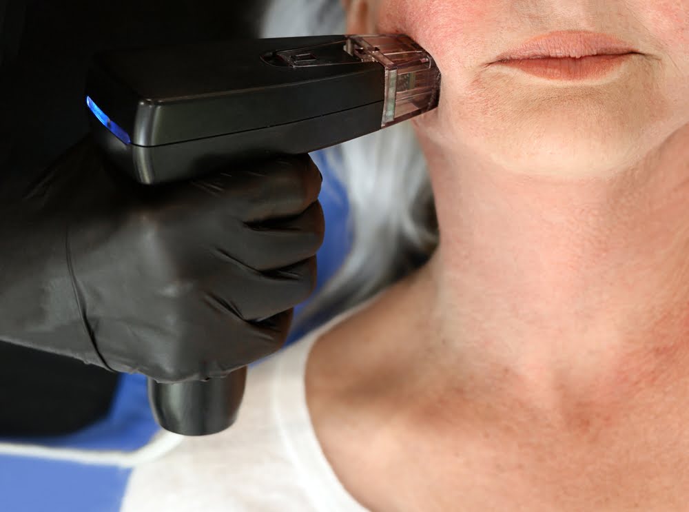 Provider applying Morpheus8 RF microneedling handpiece to patient jawline for Morpheus8 treatment in Grapevine TX at Medi-Elite