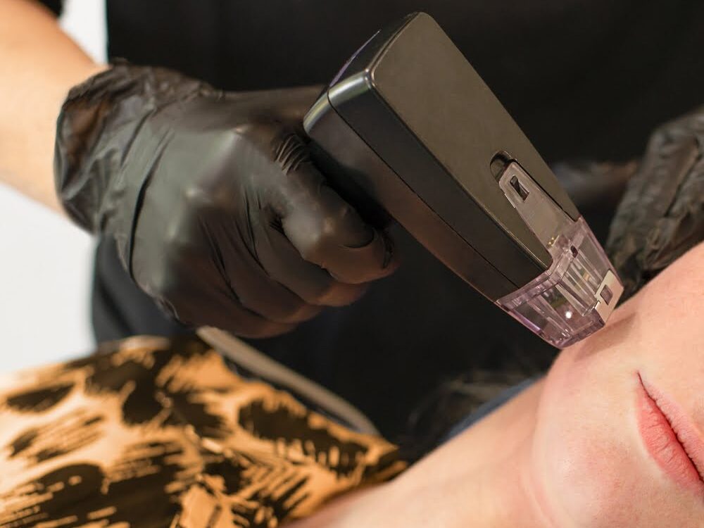 What Is the Difference Between Morpheus8 and Morpheus8 Burst? 7 Gloved provider applying a Morpheus8 RF microneedling handpiece to a patient's cheek to illustrate the difference between Morpheus8 vs Morpheus8 Burst treatment protocols