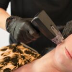 Gloved provider applying a Morpheus8 RF microneedling handpiece to a patient's cheek to illustrate the difference between Morpheus8 vs Morpheus8 Burst treatment protocols