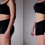Side-by-side before and after comparison showing visible Quantum RF results with a slimmer, more contoured midsection following a body contouring treatment course