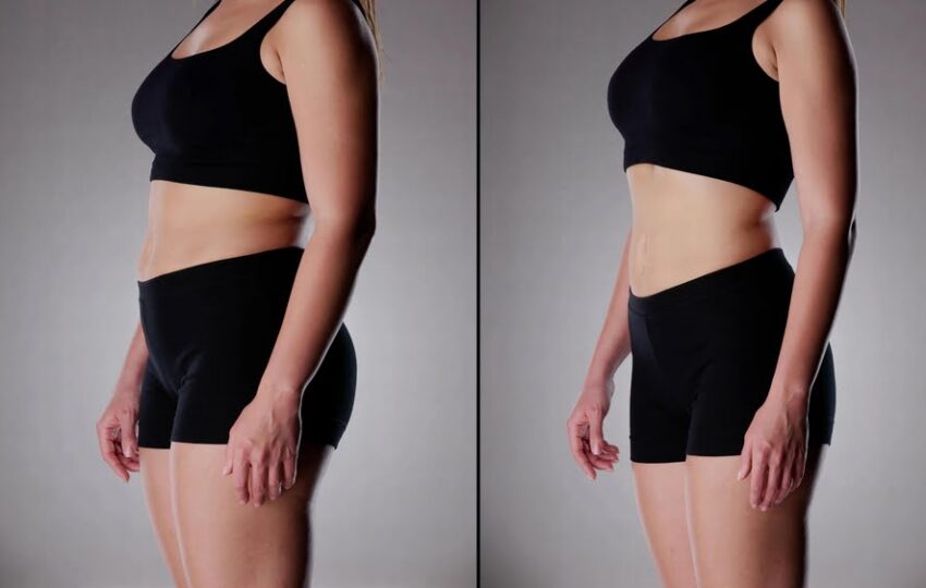 What Results Can You Realistically Expect From Quantum RF? 1 Side-by-side before and after comparison showing visible Quantum RF results with a slimmer, more contoured midsection following a body contouring treatment course