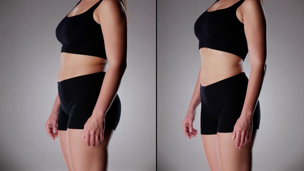 What Results Can You Realistically Expect From Quantum RF? 3 Side-by-side before and after comparison showing visible Quantum RF results with a slimmer, more contoured midsection following a body contouring treatment course