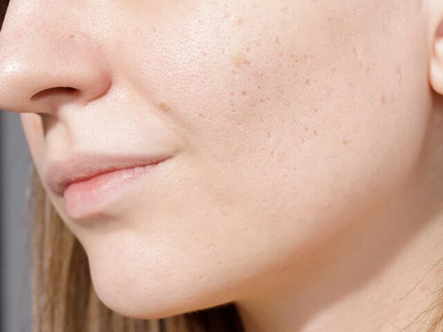 Can Morpheus8 Help With Acne Scars? What the Research Actually Shows