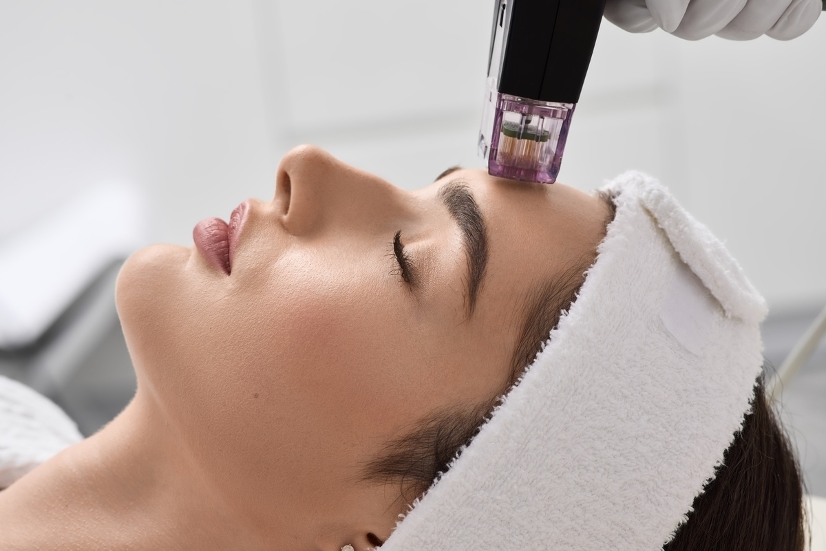 RF microneedling handpiece treating forehead during Morpheus8 Treatment in Southlake