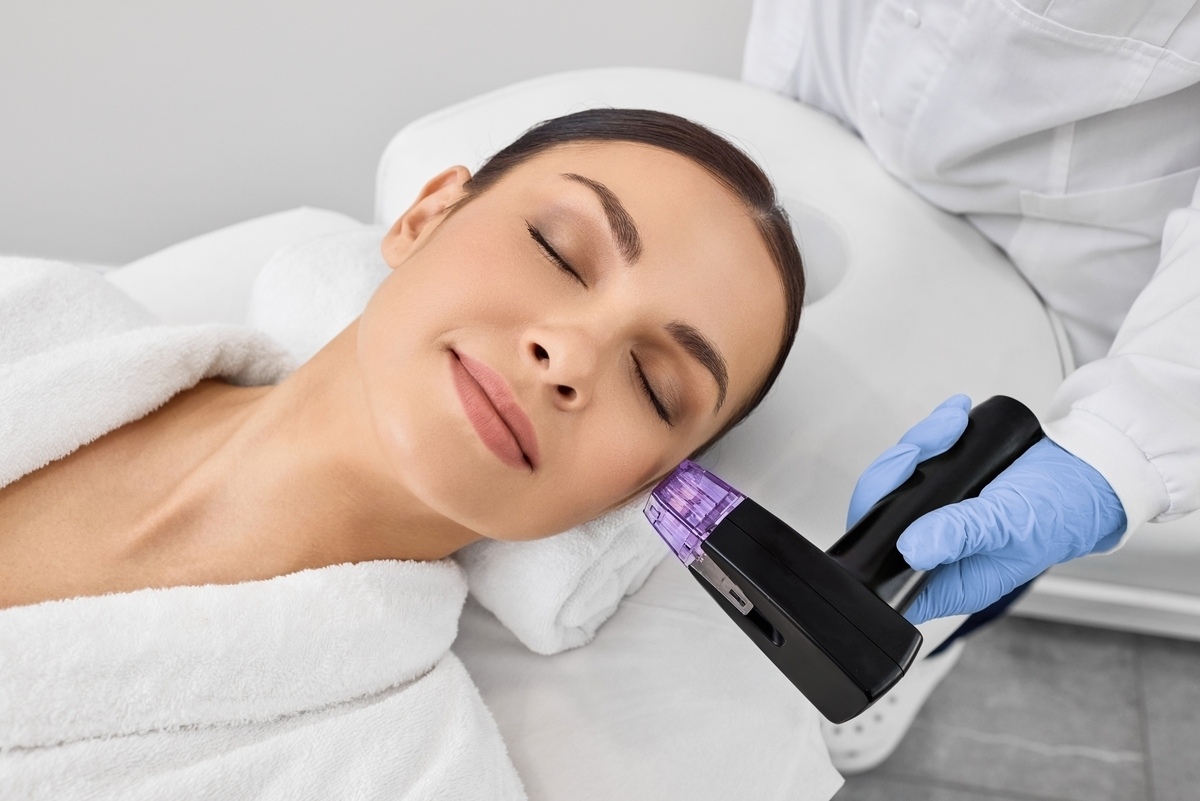 RF microneedling handpiece treating cheek during Morpheus8 Treatment in Watauga