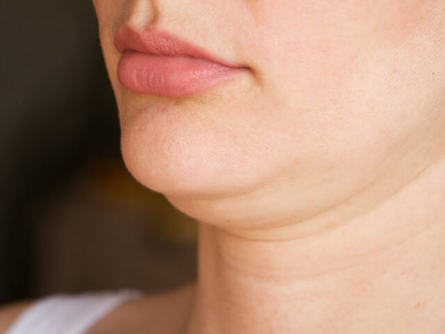 How Does Quantum RF Compare to Kybella for Double Chin Treatment?
