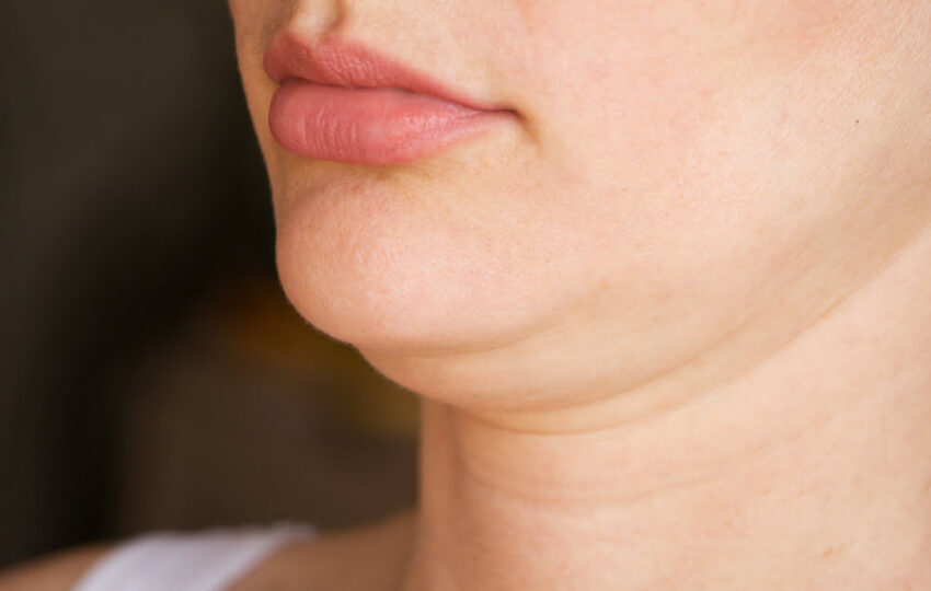 How Does Quantum RF Compare to Kybella for Double Chin Treatment? 3 Close-up of a woman's chin and neck showing submental fullness and early neck laxity representing the double chin concern addressed by Quantum RF vs Kybella treatment options