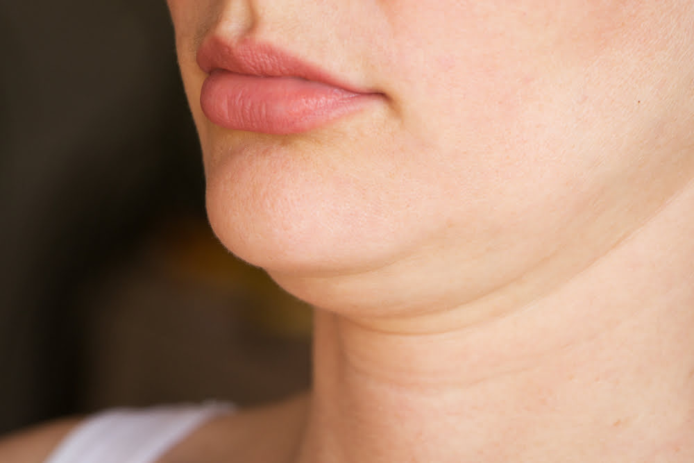Close-up of a woman's chin and neck showing submental fullness and early neck laxity representing the double chin concern addressed by Quantum RF vs Kybella treatment options