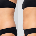 Side-by-side before and after comparison showing abdominal body contouring results on how to prepare for Morpheus8 treatment helps achieve