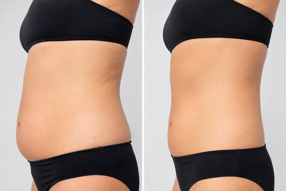 Side-by-side before and after comparison showing abdominal body contouring results on how to prepare for Morpheus8 treatment helps achieve