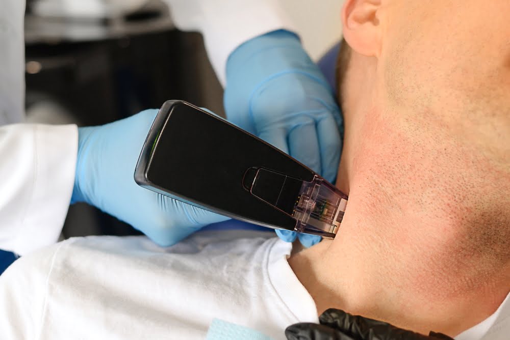 How Long Do Morpheus8 Results Last? What to Expect Year by Year 3 Provider applying a Morpheus8 RF microneedling handpiece to a male patient’s jawline and neck area, illustrating how long do Morpheus8 results last with consistent treatment sessions.